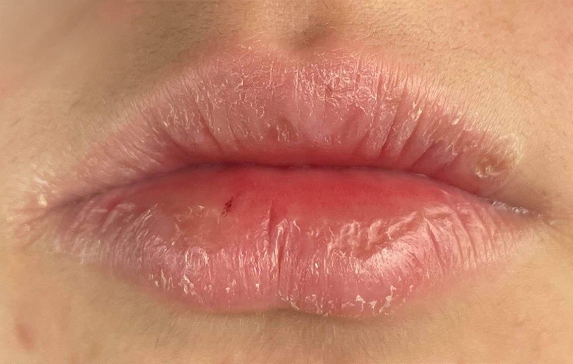 Close up image showing dry, crack lips before using Lanolips' The Original 101 Ointment Mulitpurpose Superbalm. There’s a reason why lanolin is called Nature’s Wonder Moisturiser - it mimics the skin’s own oils to restore and protect even the driest lips. Ideal for severely chapped lips in need of intense moisture.